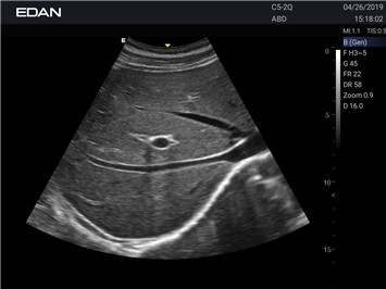 EDAN Acclarix AX2